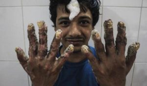 abul_bajandar_epidermodisplasia_verruciforme2_02