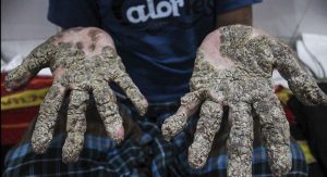 abul_bajandar_epidermodisplasia_verruciforme2_04