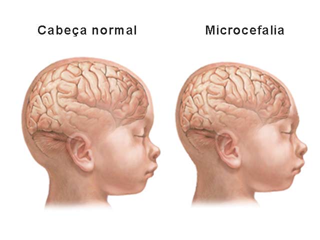 microcefalia