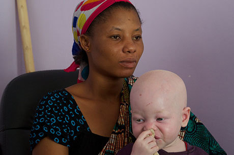 Ainda que um albino não chegue a ser vítima de um ato de violência física, Sawatzky afirma que eles convivem diariamente com o preconceito.