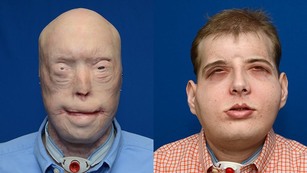 Paciente Patrick Hardison depois de acidente que deixou seu rosto deformado (esq.) e depois de receber um transplante de face (dir.)